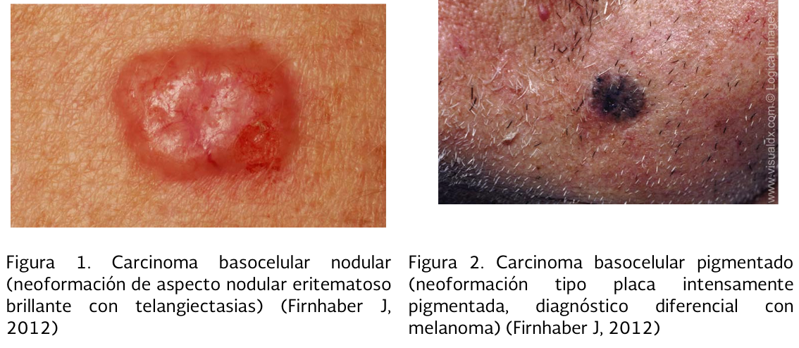 4. Cuadro clinico 1 - GPC-IMSS-360-19